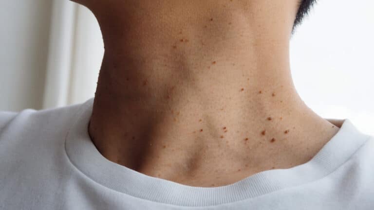 Skin Tags: What Are They & Can They Be Removed?