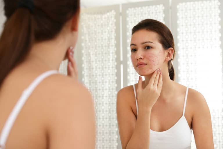 Breakouts And Red Skin? Could Be Rosacea